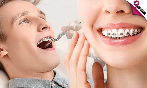 Metal Dental Braces!